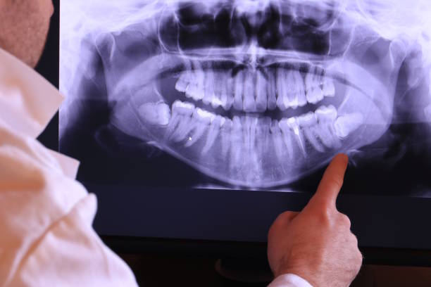 Best Emergency Dentist for Lost Fillings or Crowns in St Francis, WI